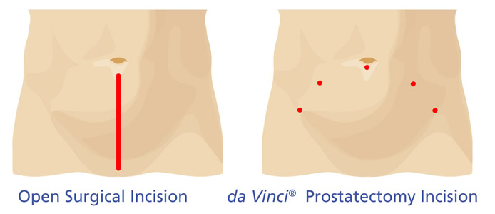 da Vinci Prostatectomy vs open Surgery