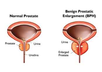 Graphic of Normal Prostate and BPH enlarged Prostate