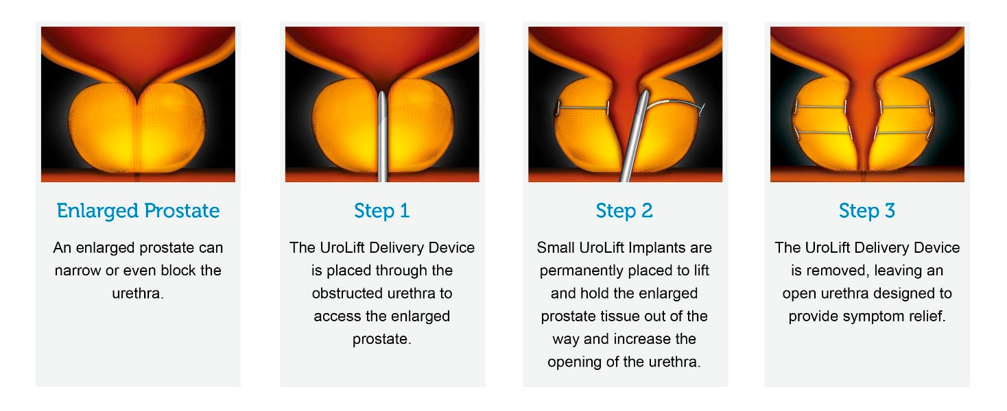 BPH UroLift Enlarged Prostate and Three Steps of Delivery of Device leaving an open urethra