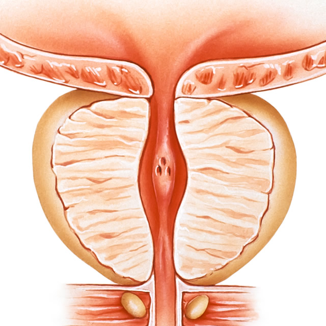 BPH Benign Prostatic Hyperplasia