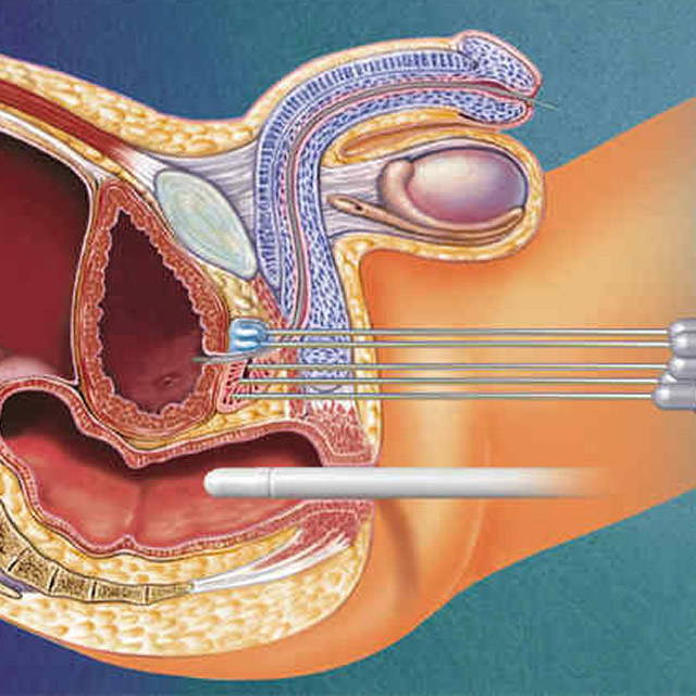 Brachytherapy