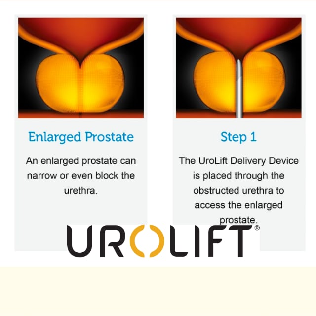 Urolift BPH Treatment San Jose, CA